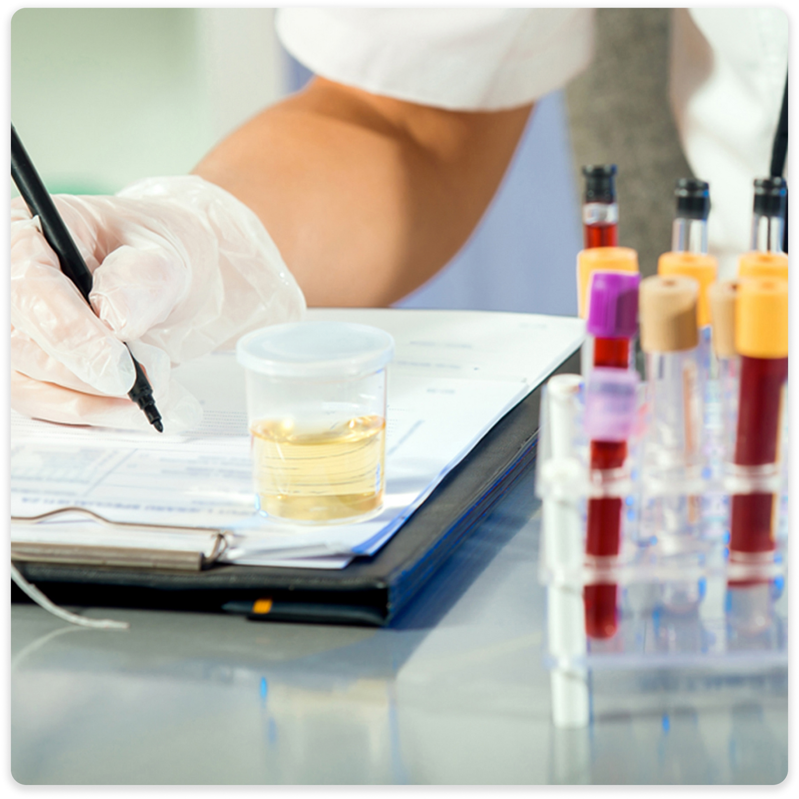 Urine Specific Gravity (USG)
